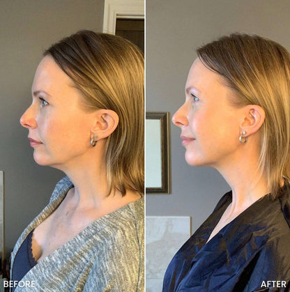 UltraFirm™ Fat Iron | Crepey Skin Eraser