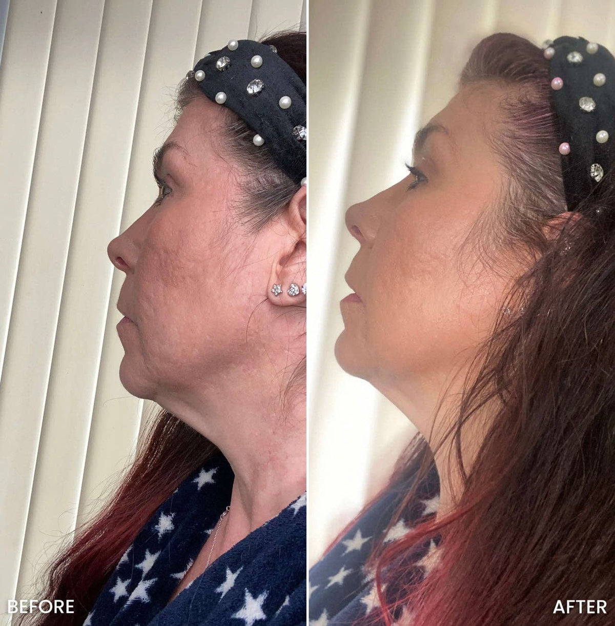 UltraFirm™ Fat Iron | Crepey Skin Eraser