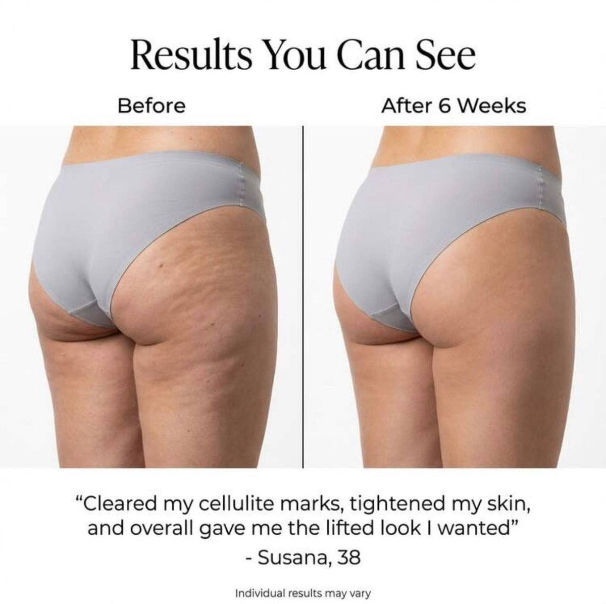 UltraFirm™ Fat Iron | Crepey Skin Eraser